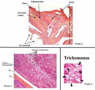 trichomonose+6.jpg